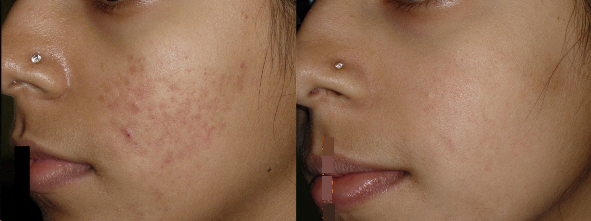 eDermaStamp® by Dermaroller® Dermaroller® MicroNeedling Collagen