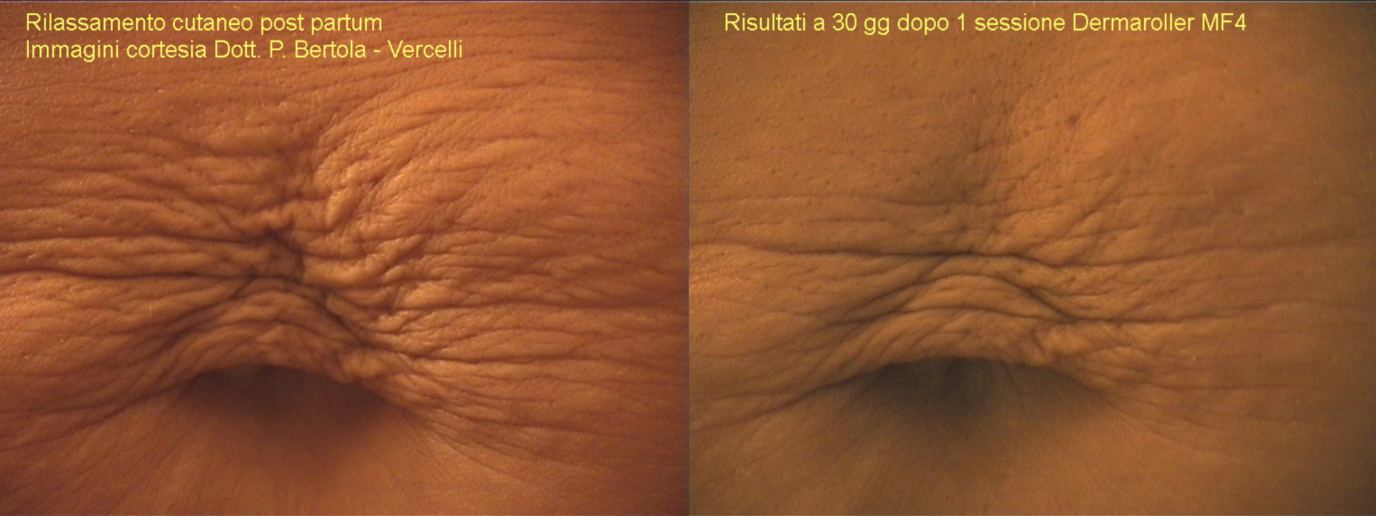 eDermaStamp® by Dermaroller® Dermaroller® MicroNeedling Collagen