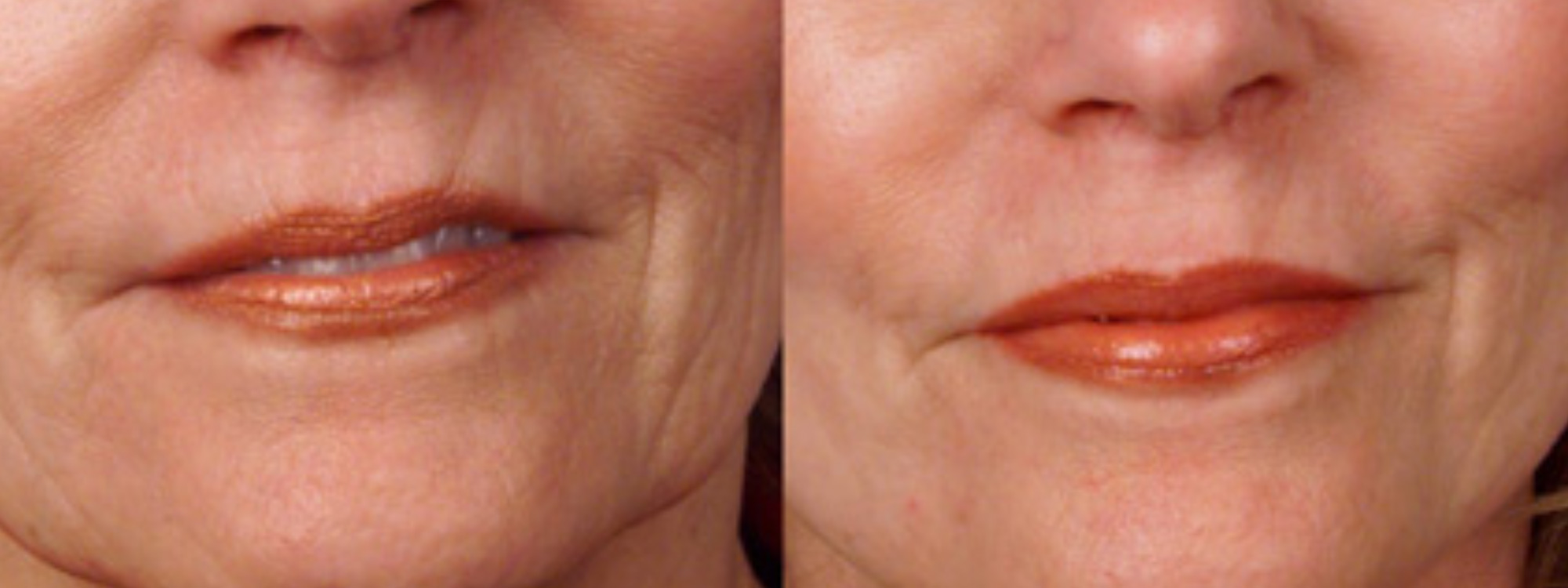 eDermaStamp® by Dermaroller® Dermaroller® MicroNeedling Collagen