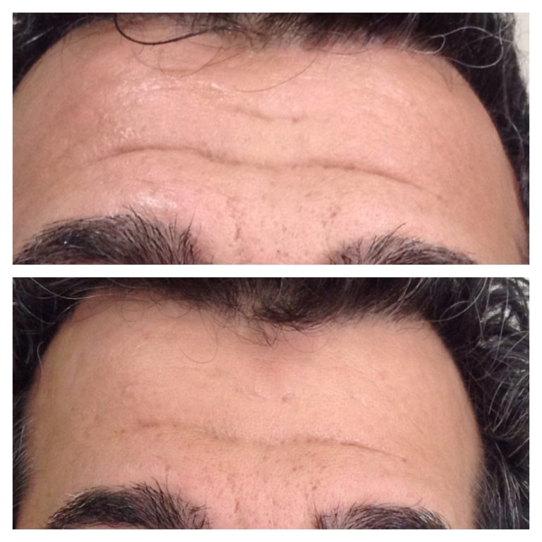 eDermaStamp® by Dermaroller® Dermaroller® MicroNeedling Collagen