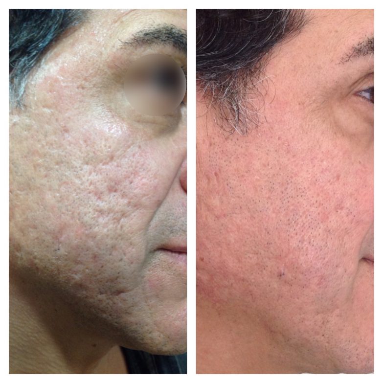 eDermaStamp® by Dermaroller® Dermaroller® MicroNeedling Collagen