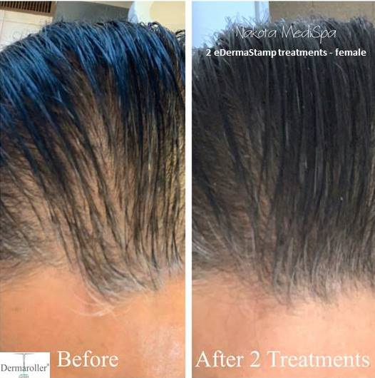 Hair & Scalp Treatment | Dermaroller® Micro-Needling | Collagen Induction  Therapy