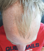 Male Pattern Baldness